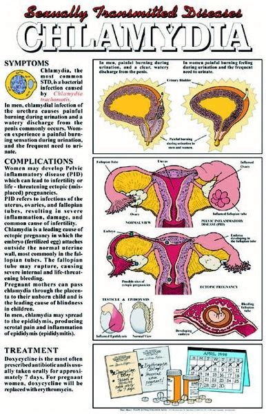 Chlamydia Poster Safe Sex Poster Charts Buyamag Buyamag Inc