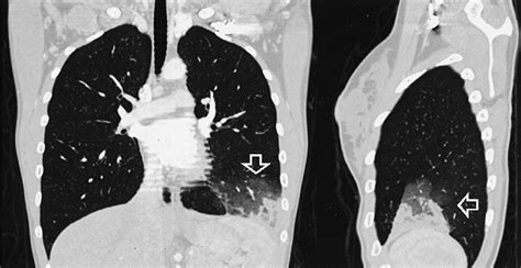 Spiral Computed Tomography For Acute Pulmonary Embolism Circulation