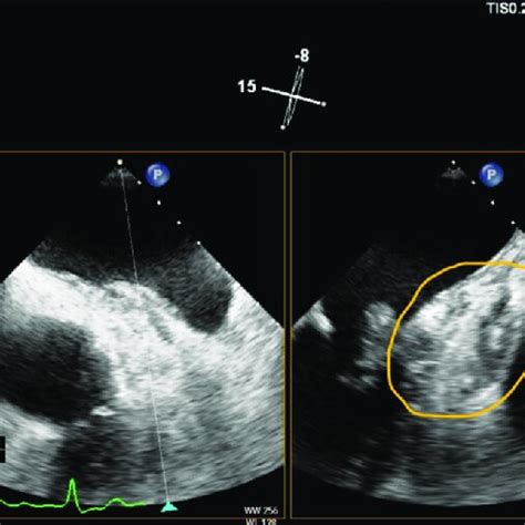 Transoesophageal Echocardiogram Showing Aortic Root Abscess Download