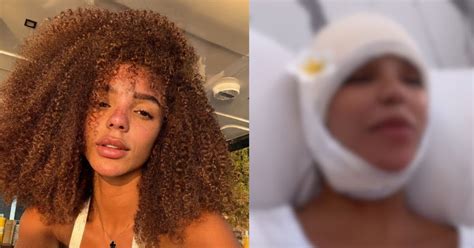 Antes E Depois De Brunna Gon Alves Esposa De Ludmilla Faz Cirurgia