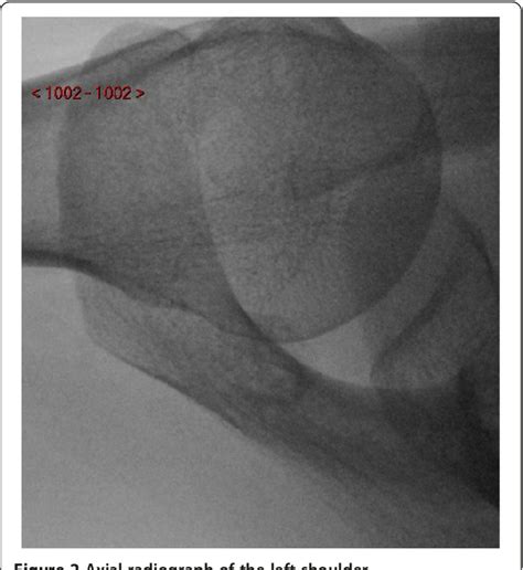 Figure 6 From Subacromial Impingement Syndrome In A Patient With