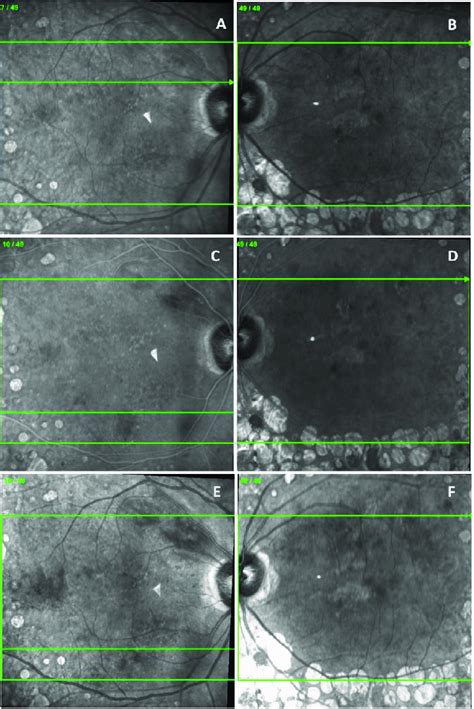 Optical Coherence Tomography Near Infrared Images Heidelberg Download Scientific Diagram