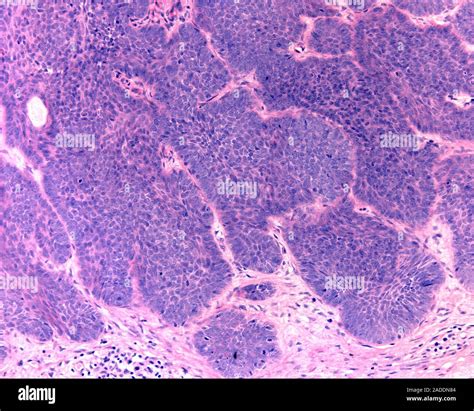 basal cell carcinoma bcc light micrograph intense proliferative