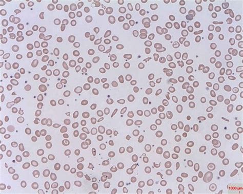 Anaemia Overview Normocytic Macrocytic Microcytic