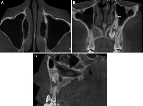 A Rare Case Of Nasolacrimal Duct Partial Obstruction After Extraction