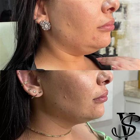 Ultraformer Antes E Depois