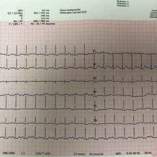 Electrocardiography Revealed Only Sinus Tachycardia With Otherwise