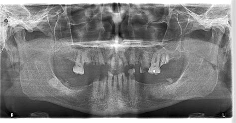 Costa Rica Dental Implant Need Digital Panoramic Xray