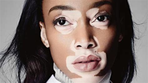 Vitiligo- Symptoms, Causes and Treatment Options