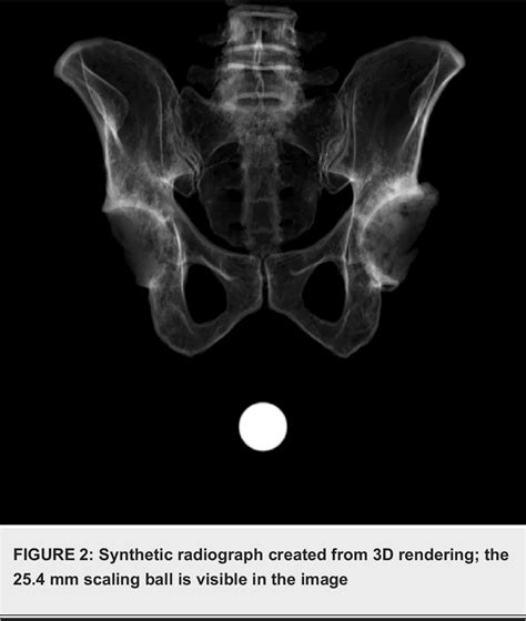 Figure 2 From A Novel Method For Correcting Pelvic Tilt On