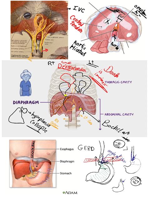 Diaphragmatic Hernia | PDF