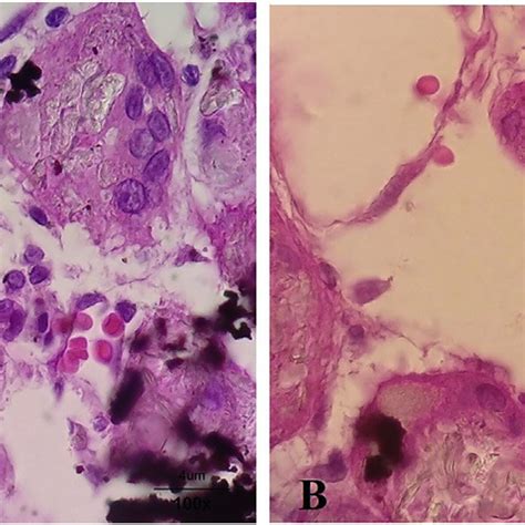 Histopathological Micrographs Demonstrating The Deposition Of Download Scientific Diagram