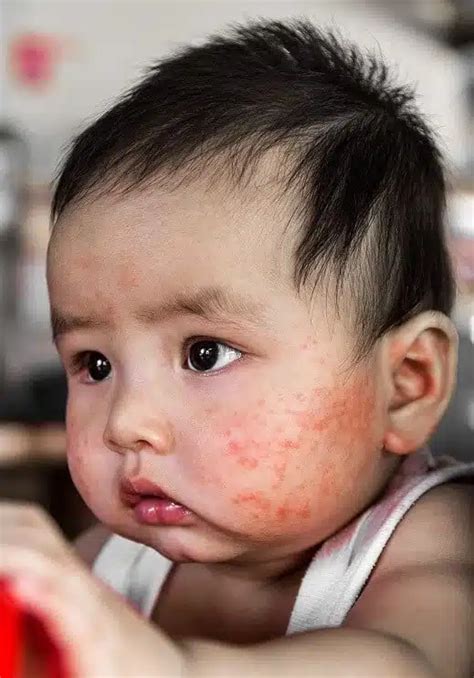 Babies and eczema | National Eczema Society