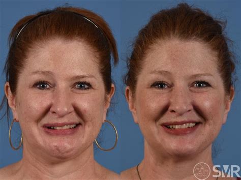 Bells Palsy Before And After Photo Gallery Dallas Tx Shai M Rozen Md Facs