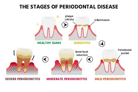 Periodontitis Symptoms Causes Diagnosis And Treatments