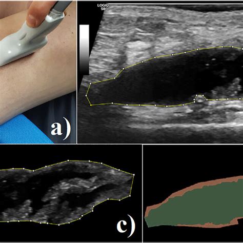 Ultrasound effusion-synovitis features. | Download Scientific Diagram