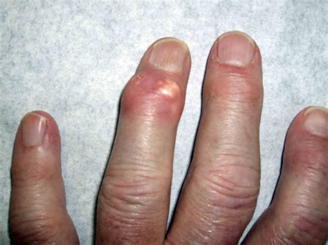 Gout Patient Information Wikidoc