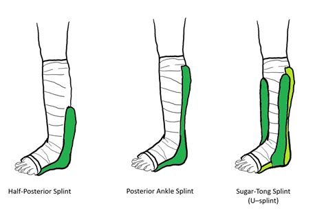 Fiberglass Splint Stirrup Sprained Ankle Splint Kit