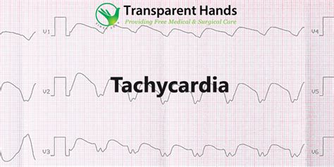 tachycardia   heart defect