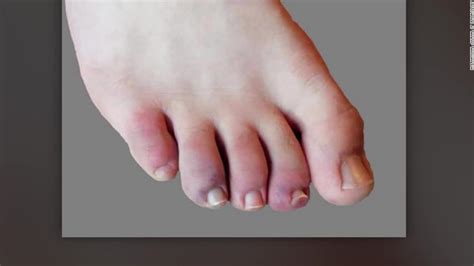 Covid Toes May Be Another Symptom Of Coronavirus Cnn Video