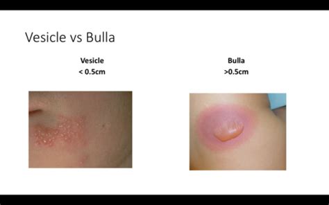 Bullous And Vesicular Rashes Trent Flashcards Quizlet