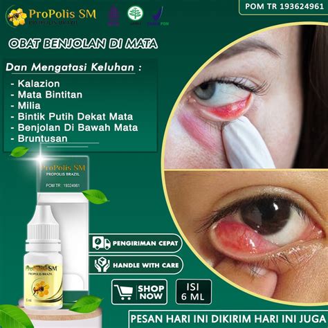 Jual Obat Benjolan Di Mata Kalazion Salep Mata Bintitan Di Dalam