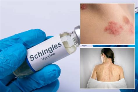 Shingles vaccine connected to significant health benefits, experts