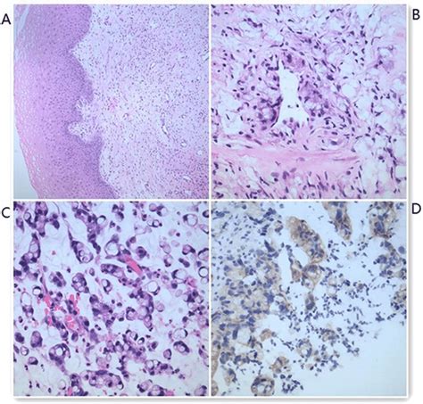 Pathological Examination A Colposcopic Biopsy Microscopic