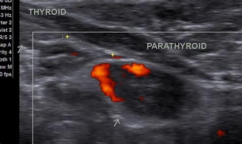 Parathyroid Ultrasound Anatomy