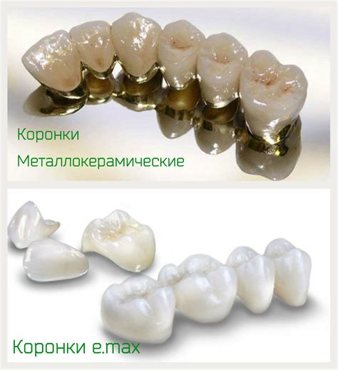 Безметалловые керамические коронки E-Max в стоматологии