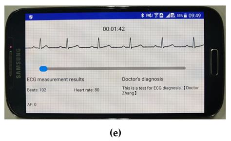 Sensors Free Full Text A Wearable Electrocardiogram Telemonitoring System For Atrial