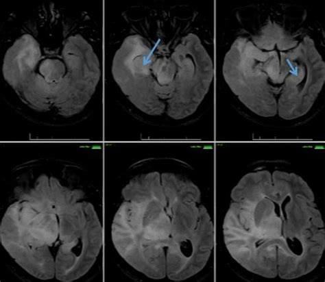 Gliomatosis cerebri. Axial FLAIR MR images show diffuse hyperintense ...