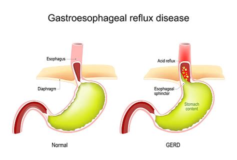 Gastroesophageal Reflux Disease Gerd Stock Illustration Download