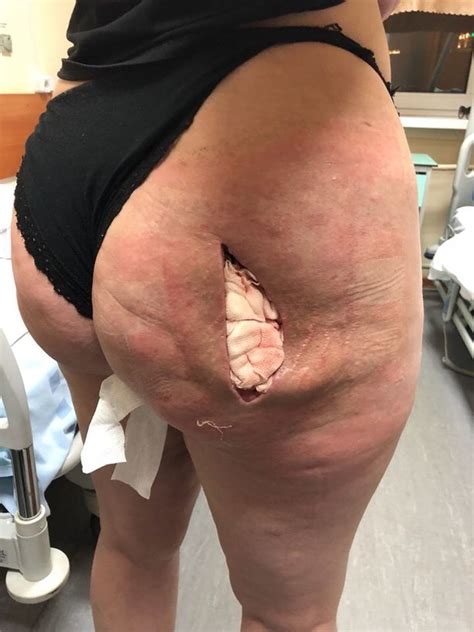 Horrific K Bum And Boob Jobs From Hell Left Woman With Hole In Buttocks World News