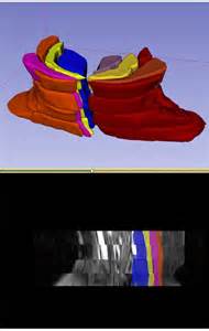 MRI-based evaluation system accurately quantifies paraspinal muscle