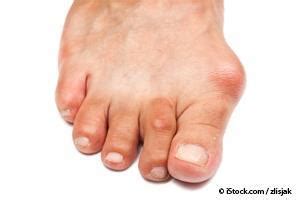 Bunions: What Is A Bunion and Its Causes, Symptoms and Treatment