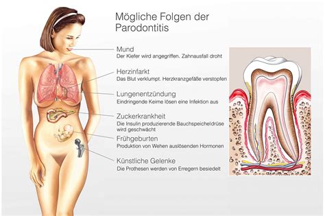 Parodontitis Therapie Bernried Biologische Zahnmedizin