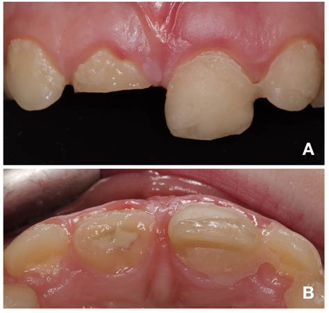 Figure 1 From Conservative Treatment Of Complicated Crown Fracture And Crown Root Fracture Of