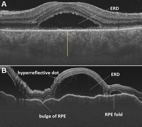 A Optical Coherence Tomography In A Posterior Scleritis Patient B