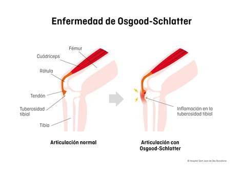 Enfermedad de Osgood-Schlatter | Escola de Salut SJD