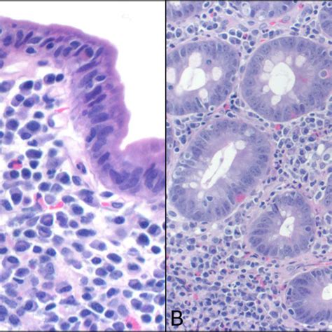 Microscopic Images Of Duodenal Biopsies Showing A Partial To B