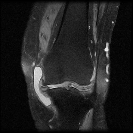 Medial Collateral Ligament Mri