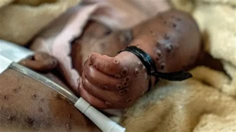 Mpox En Rd Congo Les M Decins Plaident Pour Des Vaccins Alors Que Le