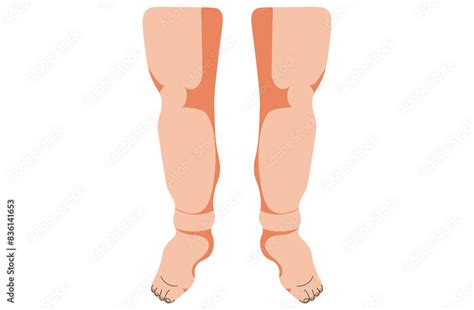 Angioedema Is A Rapid Swelling Of The Deeper Layers Of The Skin Often