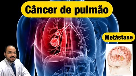 Metástase de câncer de pulmão tratamentos e perspectivas de cura