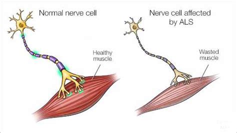 ALS (Amyotrophic Lateral Sclerosis) Treatment in Ayurveda - Dr. Vikram ...