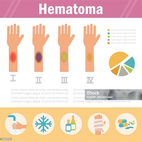 Ilustración De Etapas Del Hematoma Aislado Y Más Vectores Libres De