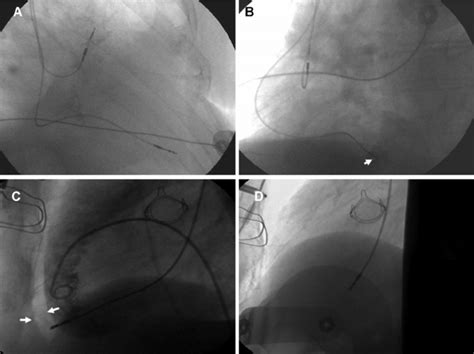 Fluoroscopy Right Anterior Oblique View Early After Implant Showed