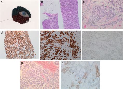 Macroscopic And Microscopic Features Of Male Breast Cancer A Typical