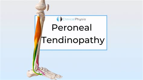 Peroneal Tendinopathy Clinical Physio Membership